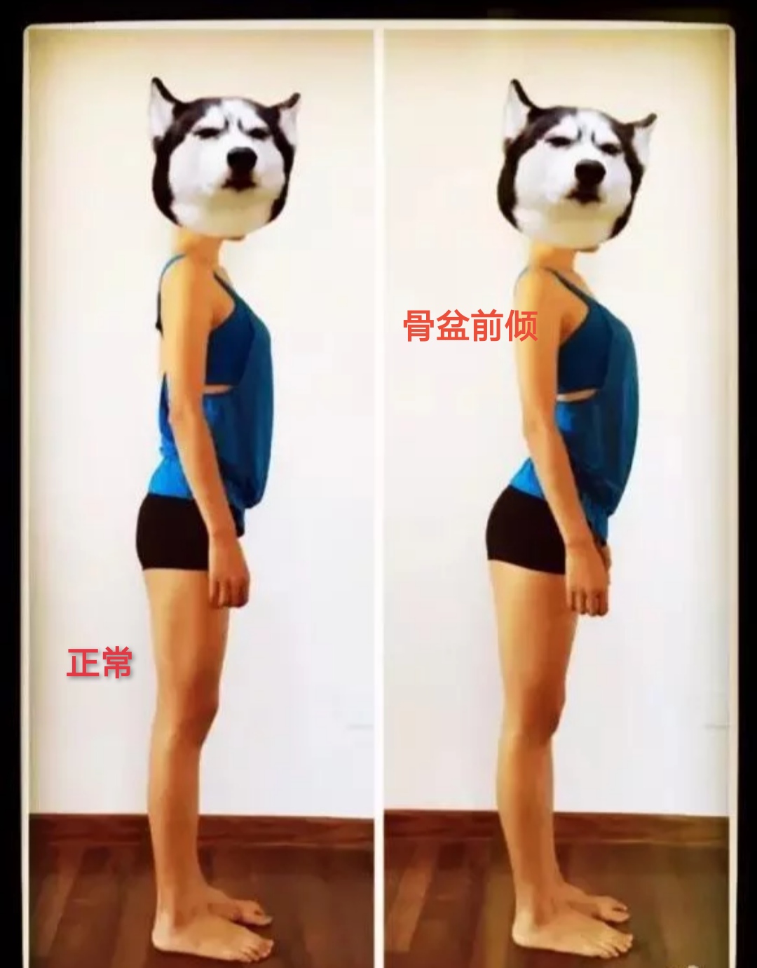 如何改善驼背和骨盆前倾,怎样改善骨盆前倾的腰疼