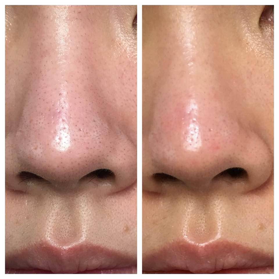 去黑头完了如何修复,去黑头省钱攻略