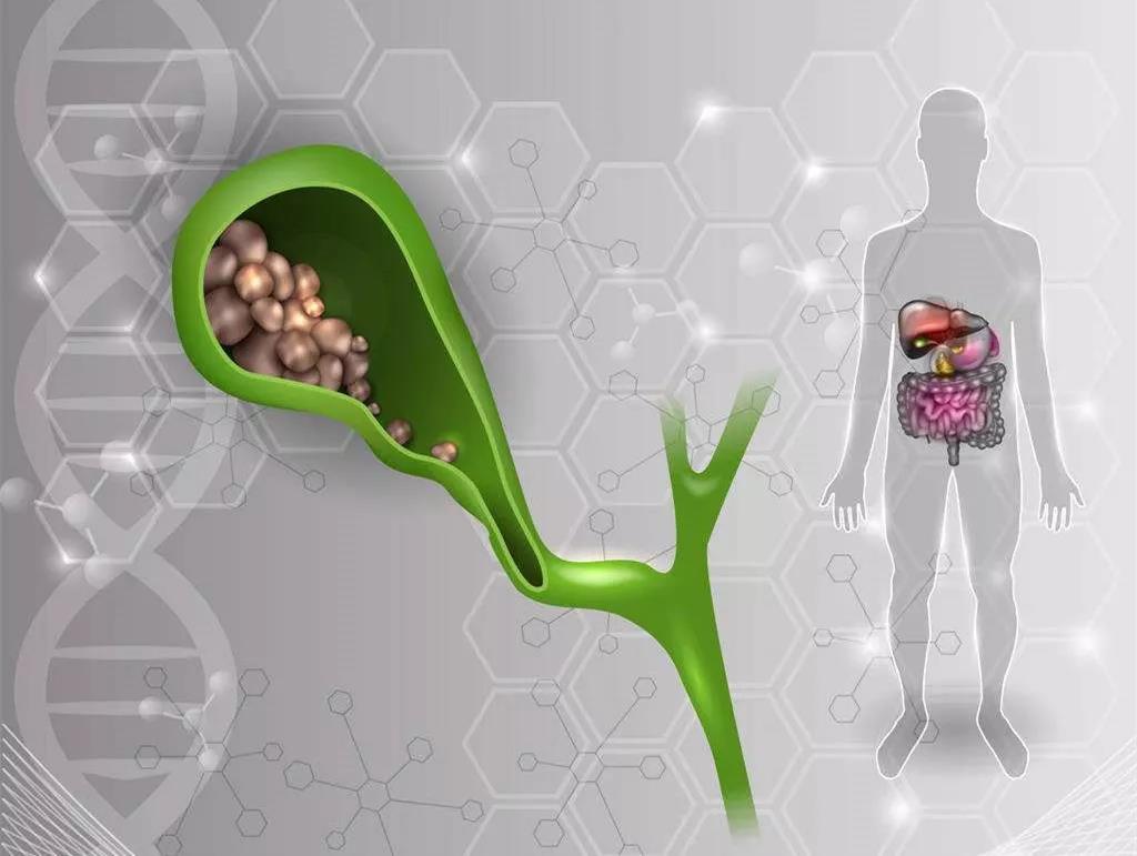 体检出胆结石无症状怎么办,体检胆结石没症状怎么办