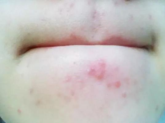 下巴长痘痘祛痘精华,下巴频繁长痘痘的正确消除方法