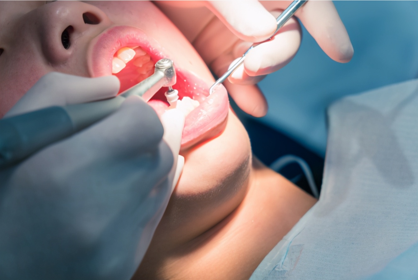 牙齿嵌体修复材料,补牙材料推荐什么品牌