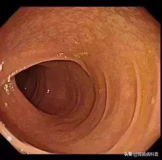 大肠变黑吃什么药好,大肠变黑便秘