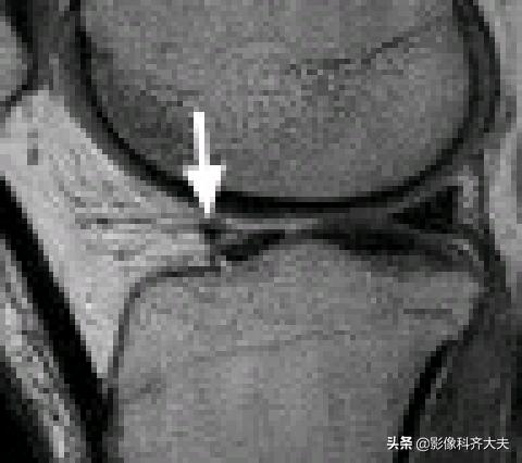 膝关节半月板损伤的磁共振,膝关节半月板病变的mri诊断与鉴别