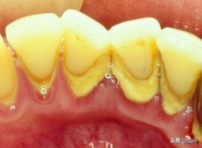 洗牙谣言,为什么很多人对洗牙有误解