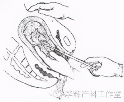 阴式分娩（自然分娩）知情同意书的专业解读