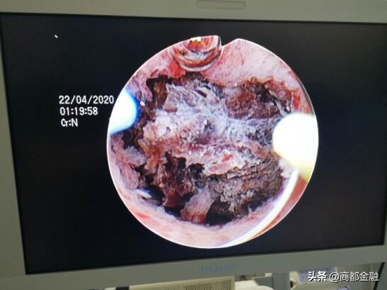 无刀口、无介入，中西医结合，简单几步轻松治疗胎盘植入