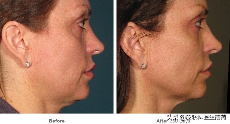 激光祛斑仪雀斑,祛斑祛红色痘印激光