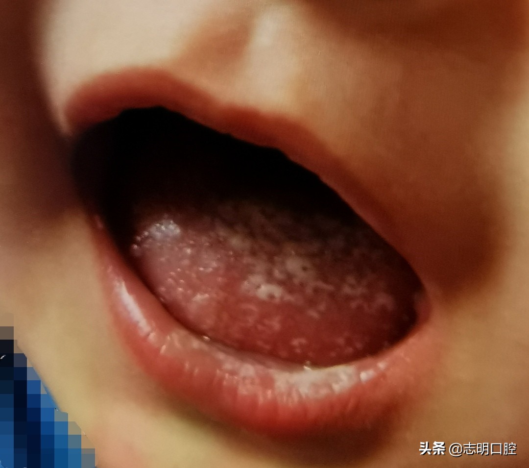 新冠时期宝宝牙病急缓如何应对