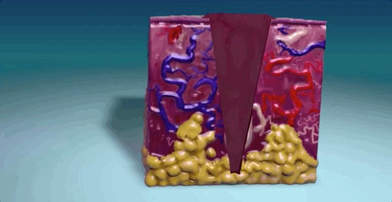 揭秘伤口如何愈合的,伤口是如何愈合的告诉小朋友