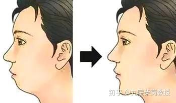 整容避坑知识,整容怎么解决脸大的问题