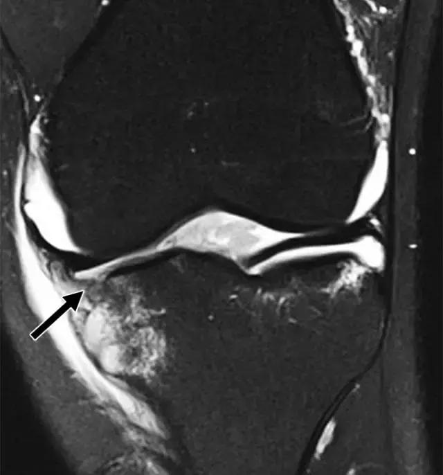 骨折处出现麻痹感,骨折跟精神状态有关