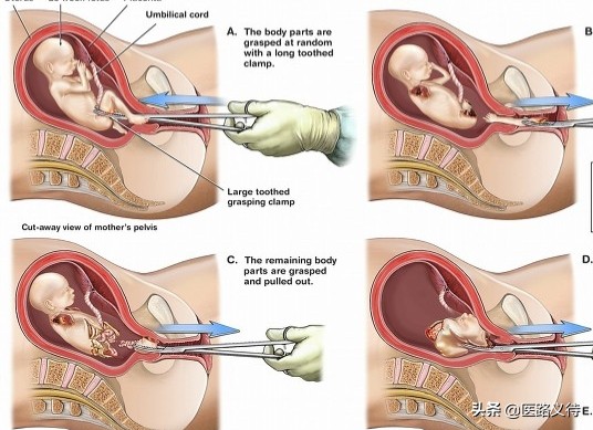 人流术后的护理及健康宣教,人流术前的健康宣教内容