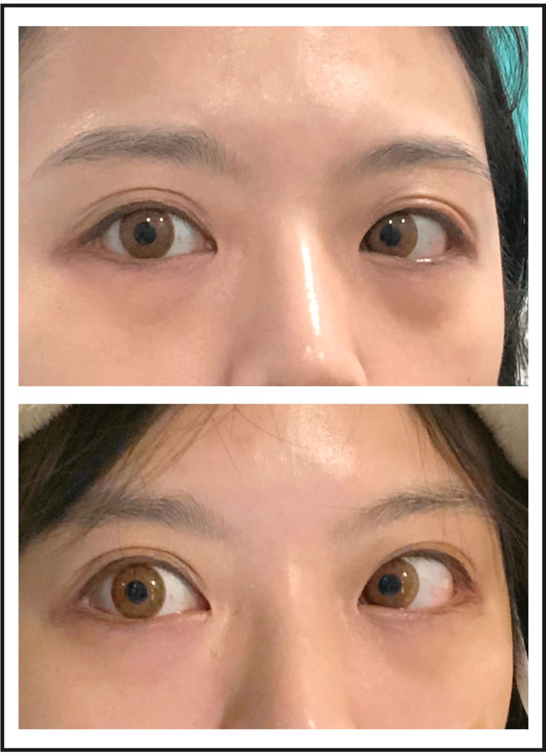 一次就能让黑眼圈消失的办法,一针下去瞬间没了黑眼圈