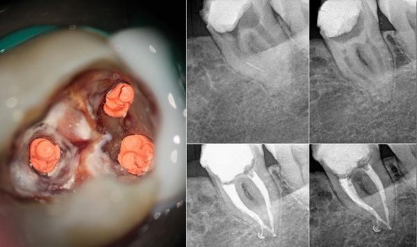 牙齿蛀牙怎么治疗,治疗蛀牙的视频