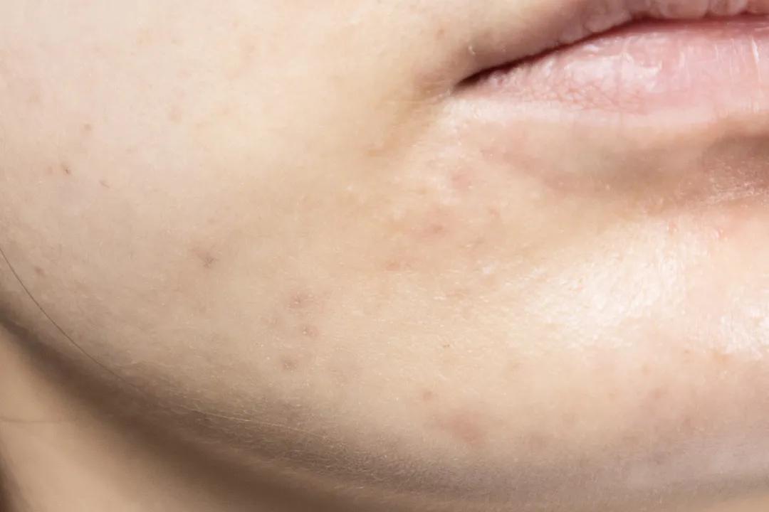 让无数姑娘无从下手的痘印，皮肤科医生有了解决新招