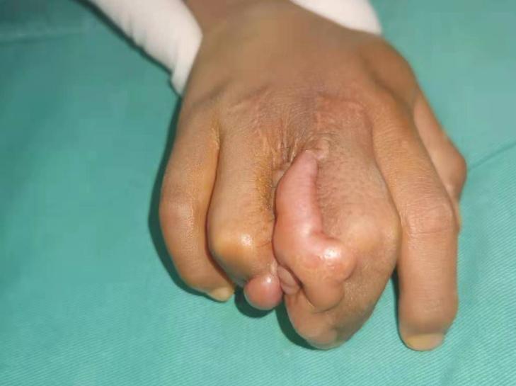 并指畸形免植皮案例,并指畸形