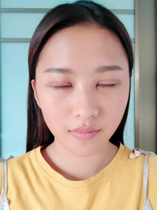 韩美做双眼皮,南昌韩美医院做双眼皮怎么样
