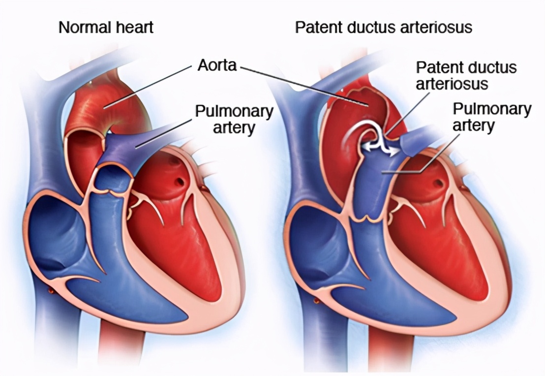 动脉导管未闭严重吗,动脉导管未闭合自愈概率