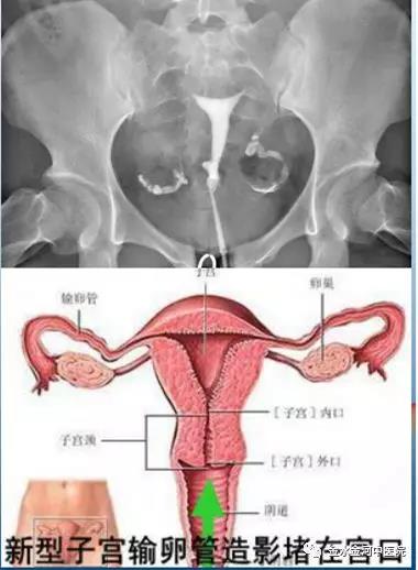 输卵管通畅度医生误诊后果严重，反复宫外孕责任在谁？