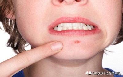 有痘疮怎么处理,有疮