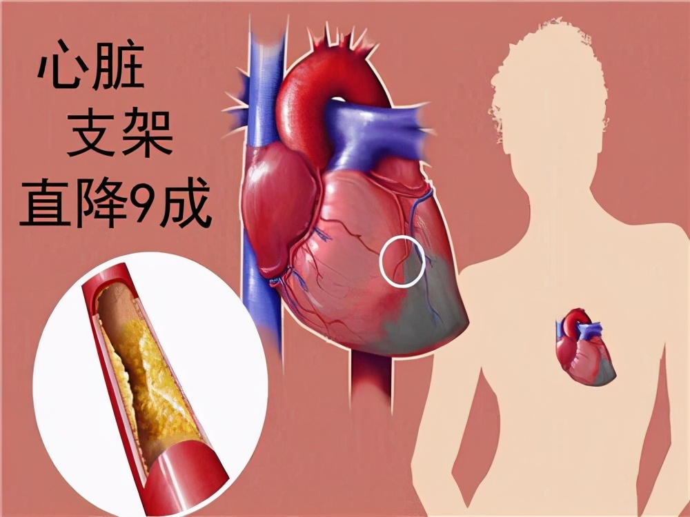 西安心脏支架报销标准,西安国际医学中心心脏支架