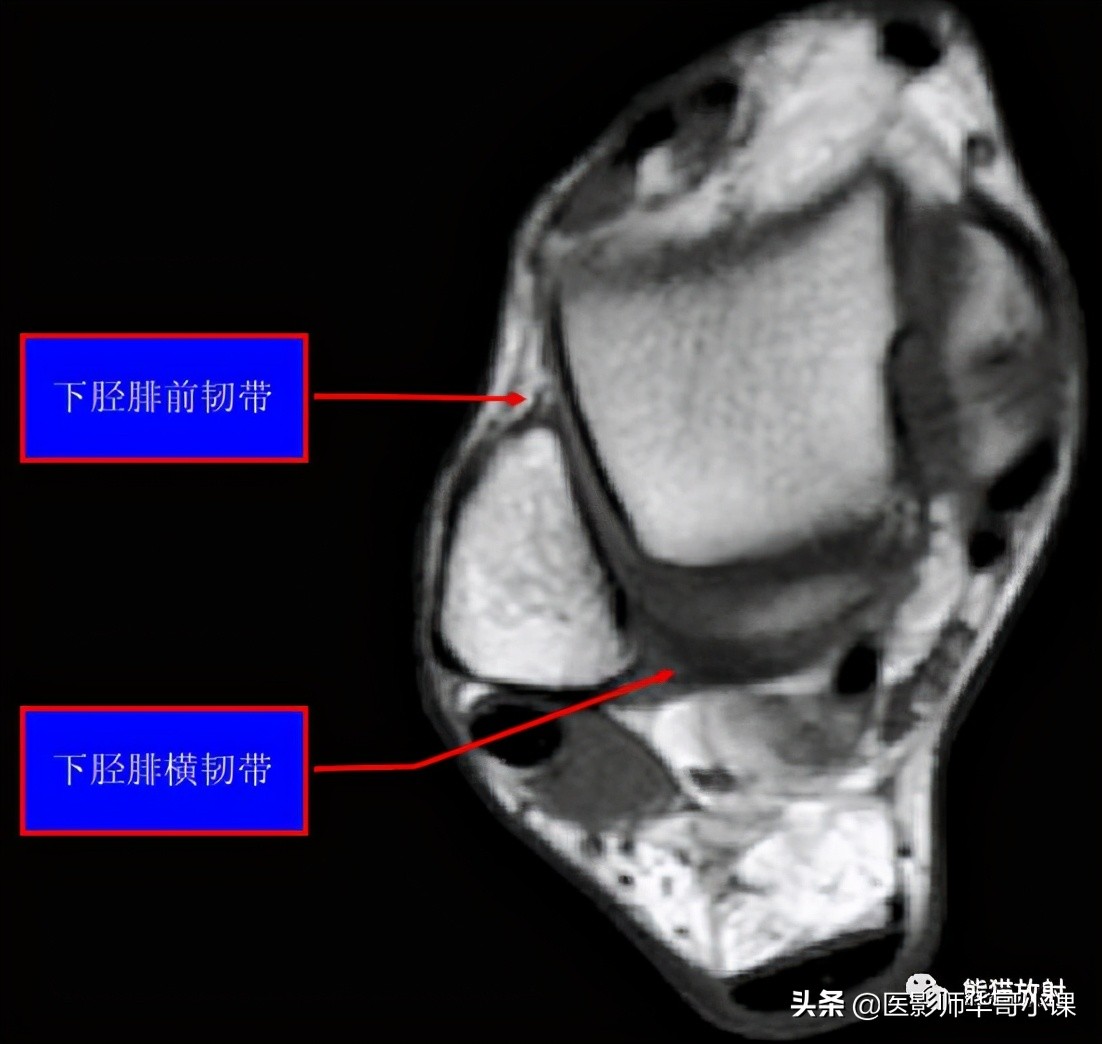 踝关节解剖视频课,解剖学韧带分布图