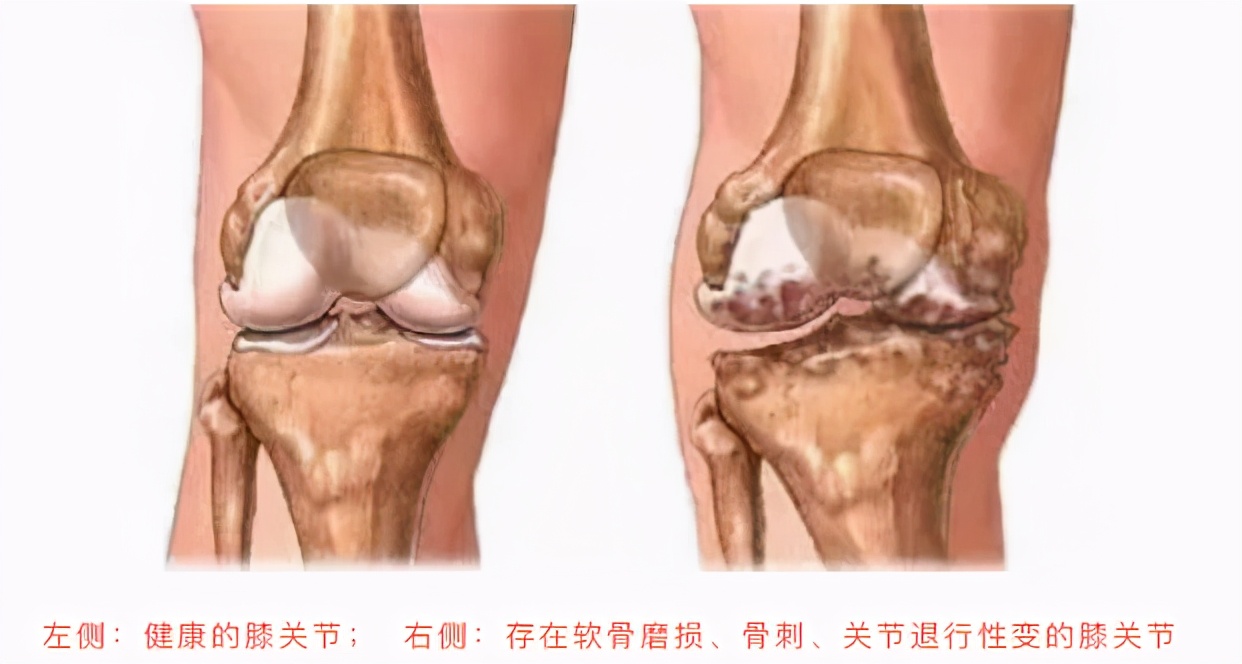 生骨刺怎么样才好得快,生骨刺的有效疗法