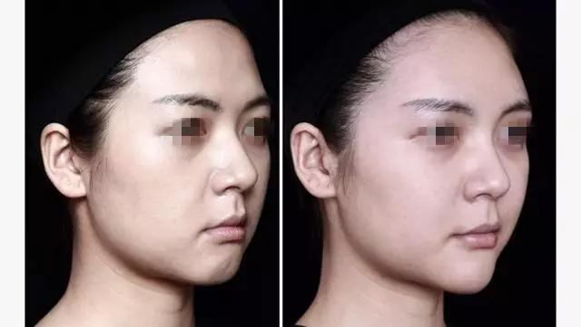 玻尿酸真的能永葆青春,明星都在用玻尿酸吗