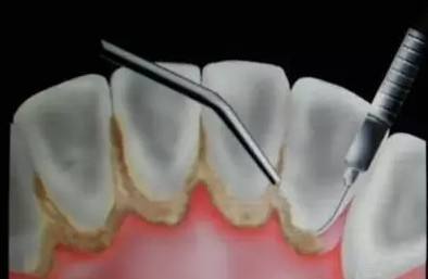 洗牙多长时间洗一回,洗牙多长时间洗一次牙垢