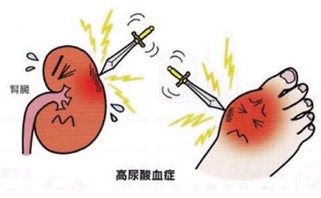 肾尿酸结晶怎么溶解排出体外,细胞代谢的尿酸怎么排出体外