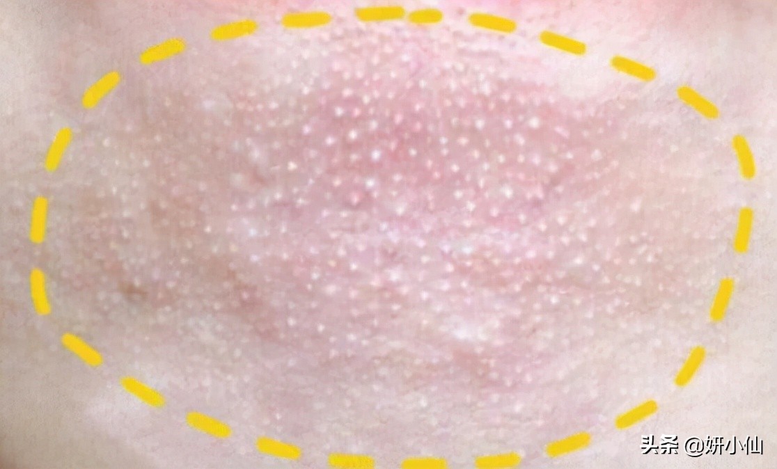 下巴长闭合性粉刺去除的方法,下巴白头粉刺是什么原因引起的