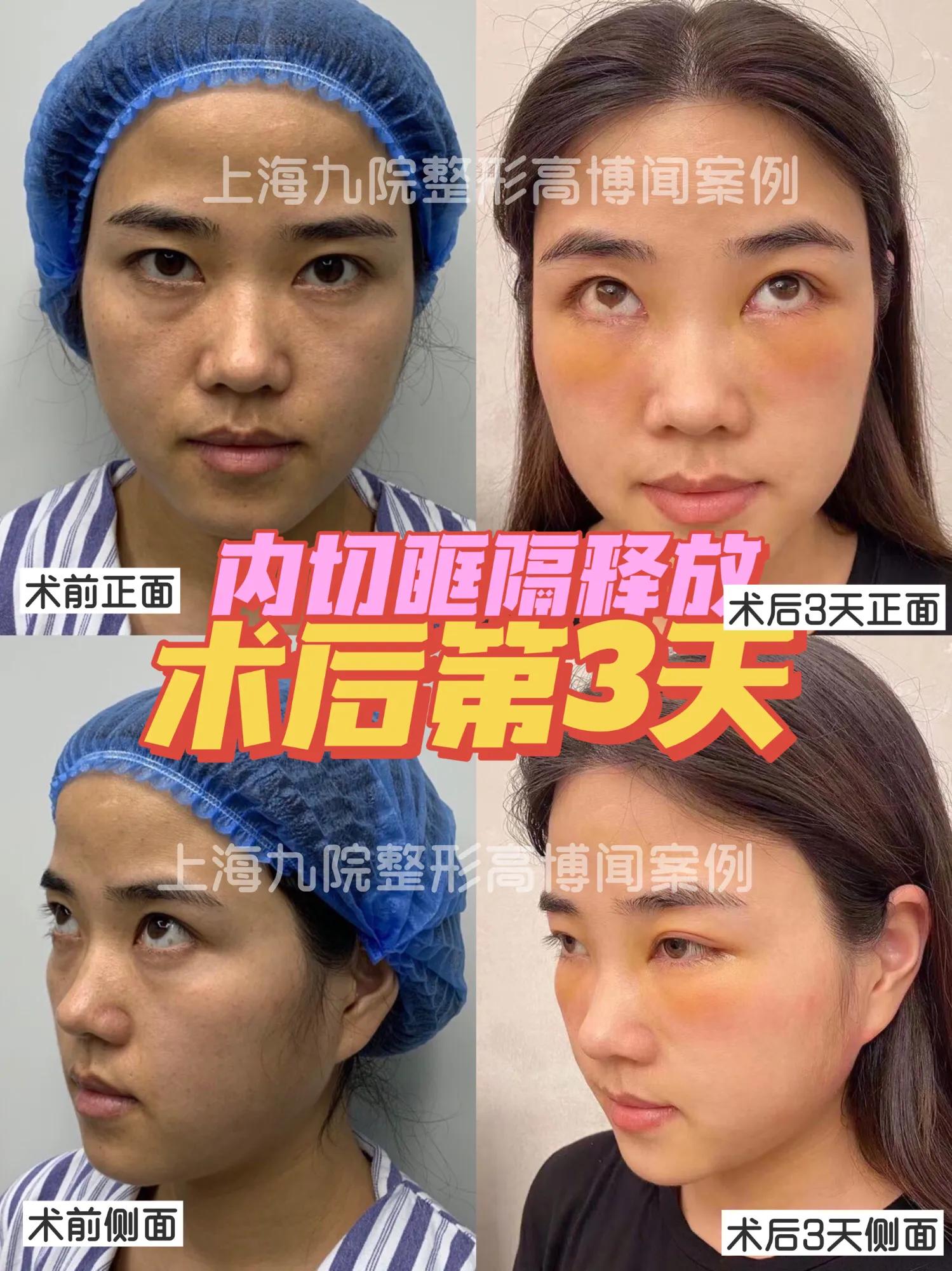 祛眼袋加眶隔释放要多久才恢复,眶隔释放眼袋术没做好怎么修复