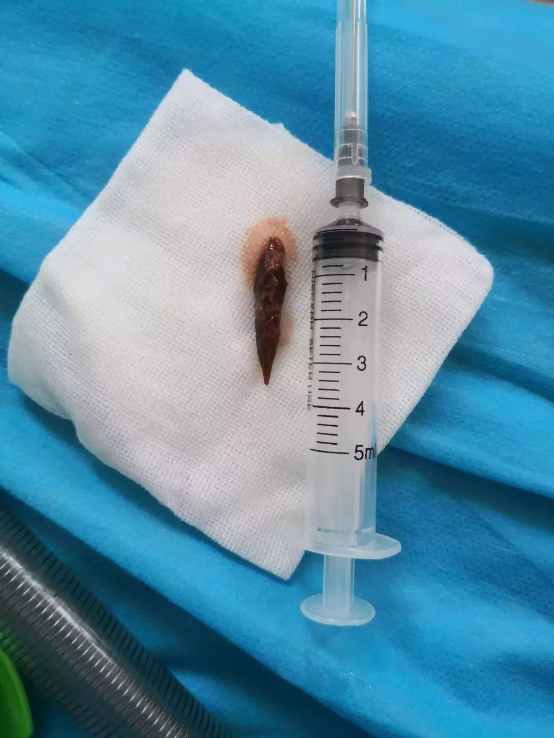 误吞枣核如果嗓子有一些疼怎么办,宝宝误吞枣核10天没症状也没排出