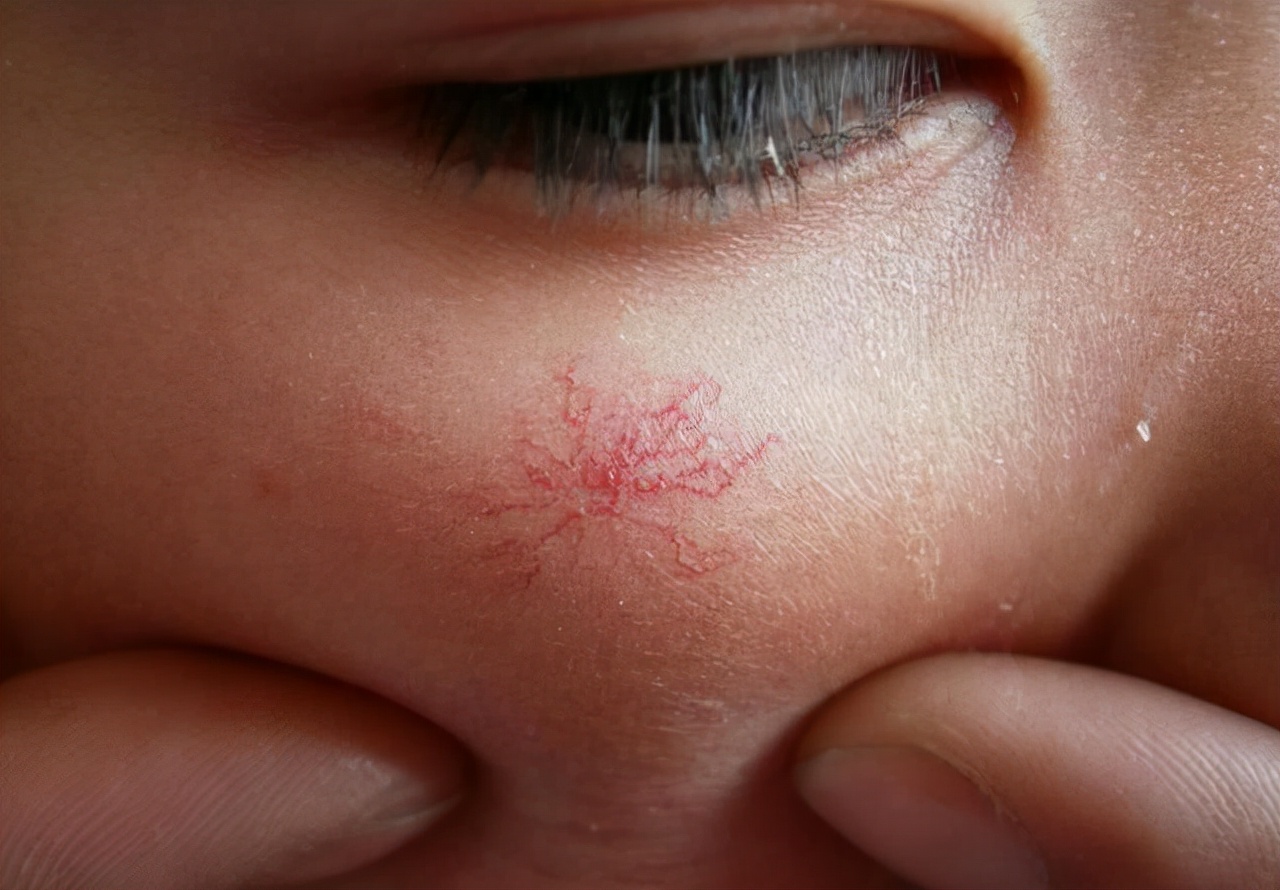 身上突然很多小红痣是什么原因,手臂上长了小红点不痛不痒像痣