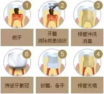 牙齿折断了能接回去么,牙外伤根中三分之一折断怎么处理