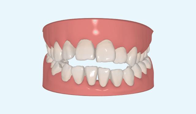 哪些小动作可以改善凸嘴,改善凸嘴的十大方法
