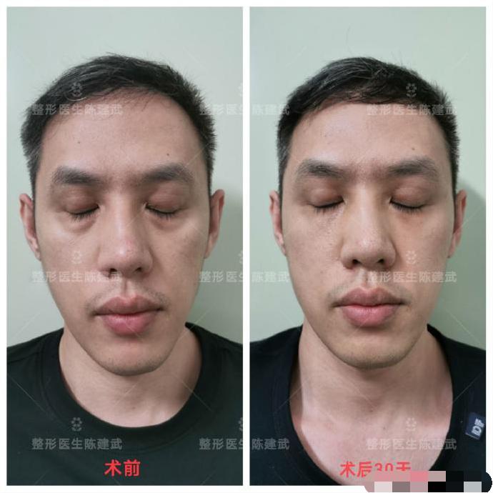 去眼袋泪沟医美方法,想了解一下去眼袋的最佳方法