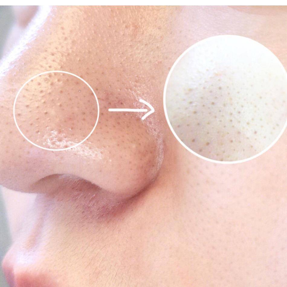 去黑头攻略：被黑头耽误的鼻子是该处理一下了