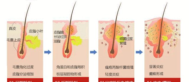 黑头太顽固教你去黑头的方法,很多黑头用什么办法去除
