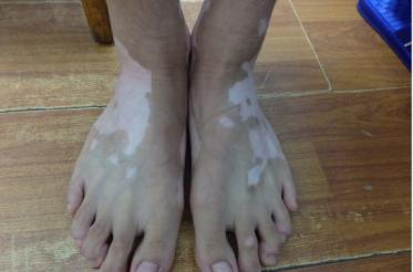 小孩脚背出湿疹怎么治疗,孩子脚面长湿疹是怎么回事