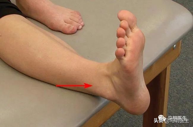 踝关节扭伤,SprainedAnkle检查、分级-双语学习