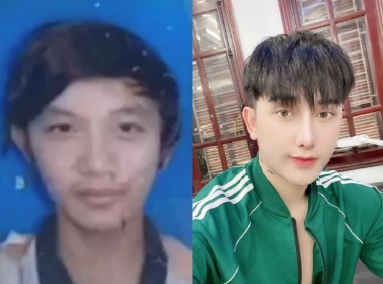 越南丑男整容变帅,越南小伙儿整容成功