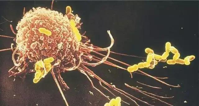 原位癌浸润癌微浸润癌区别,原位癌和微浸润癌的病理区别