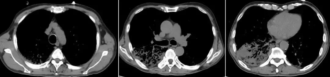 抗菌药物不合理处方分析,抗菌药物用药不合理的表现