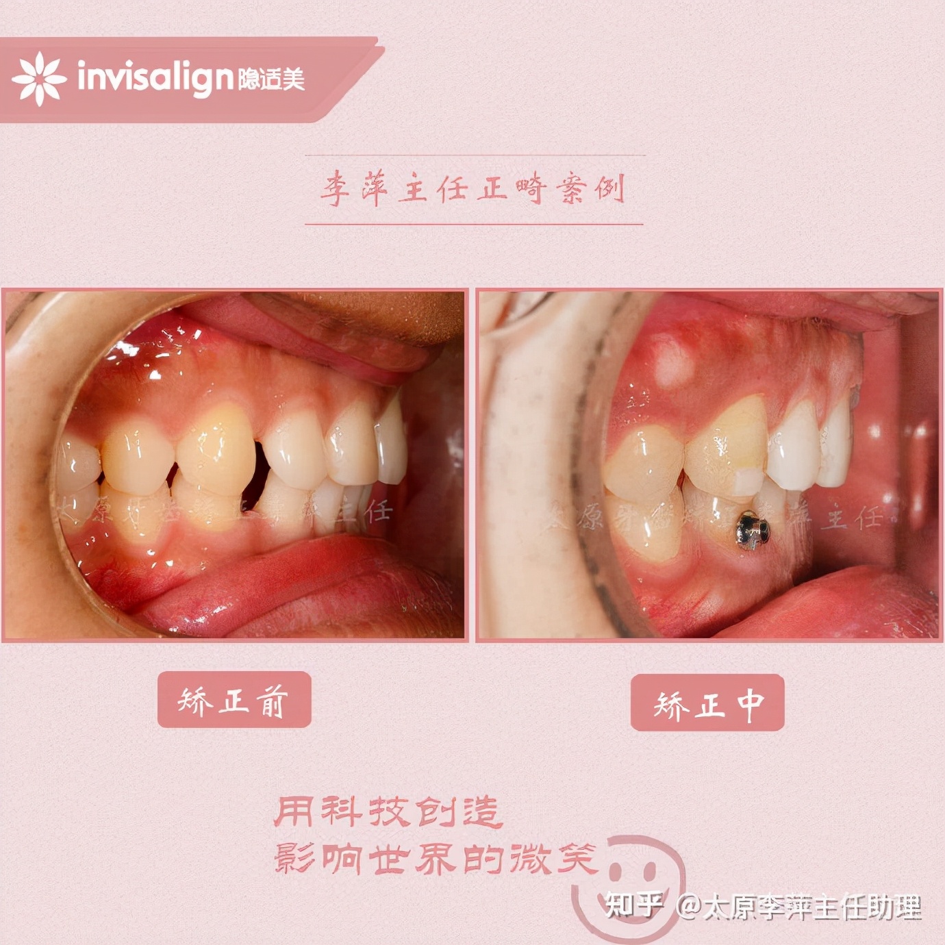 重度拥挤矫正牙齿适合隐形牙套吗,广州成人牙齿矫正推荐隐形牙套