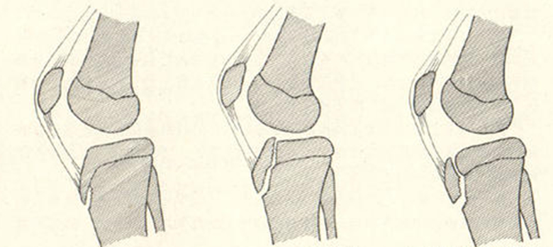 胫骨结节骨软骨病是怎么引起的,胫骨结节软骨炎不痛要治疗吗
