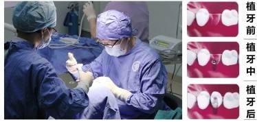 种植牙钛合金是金属吗,种植牙种植体对骨头好吗