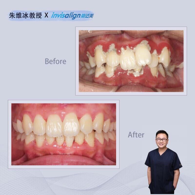 隐适美牙齿拥挤矫正真实案例,南京朱维冰
