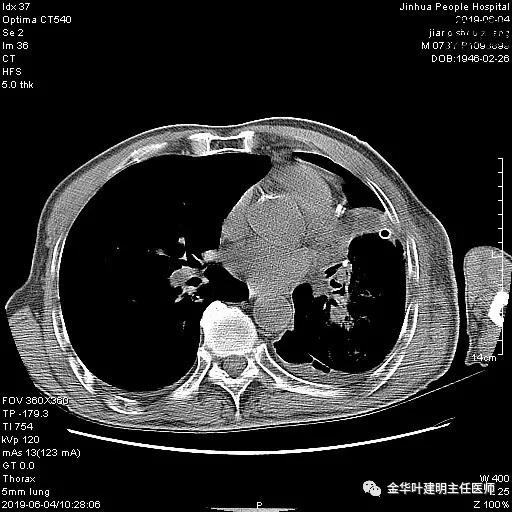 手术引起乳糜胸,有没有做了肺结节手术后是误诊的
