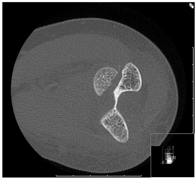 特殊骨折类型,特殊骨折体征